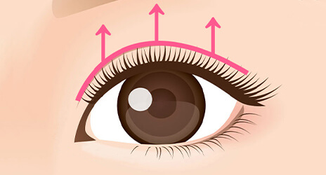 眼瞼下垂による目の開きを改善したい